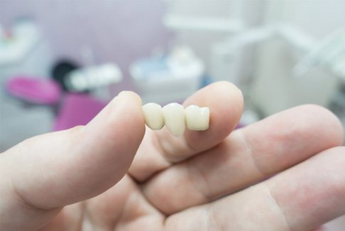Dentist holding a dental bridge 