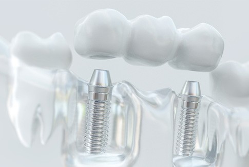 Model of a dental implant bridge