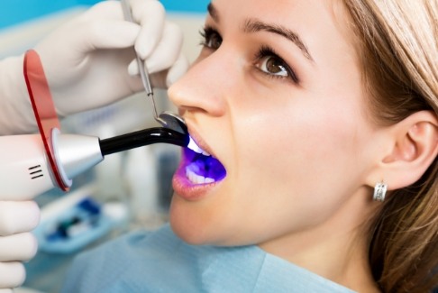 Animated smile during cosmetic dental bonding treatment