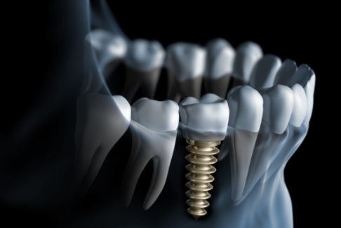 Animated smile with screw retained dental implant