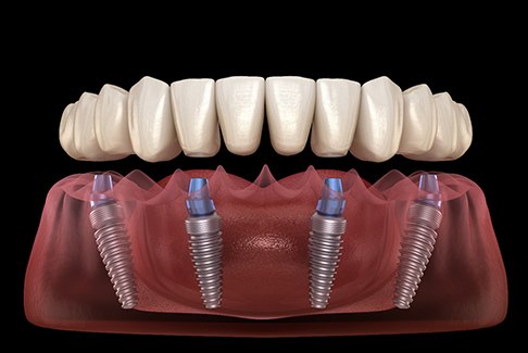 Illustration of All-on-4 dental implants in Sterling Heights, MI for lower arch