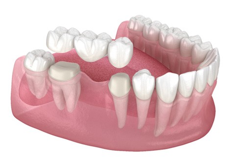 Rendering of a traditional dental bridge 