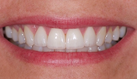 Closeup of bright smile after teeth whitening