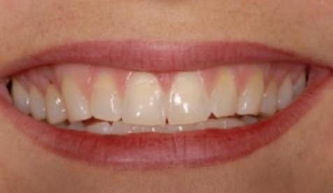 Closeup of yellowed smile before teeth whitening
