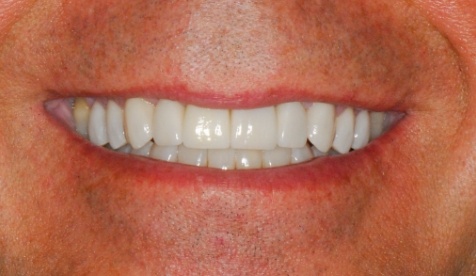 Bright healthy smile after cosmetic dentistry