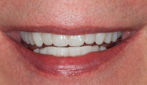 Healthy restored smile after cosmetic dentistry