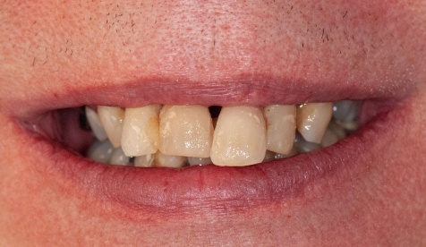 Severely discolored and damaged smile before cosmetic dentistry