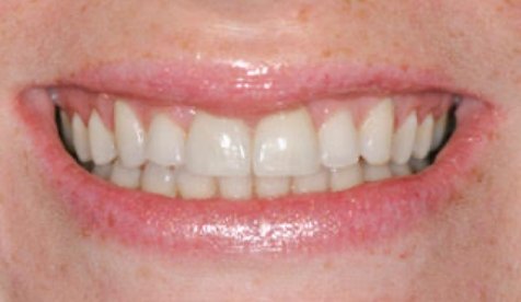 Smile with closed gap between front teeth