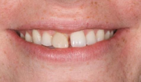 Smile with gap between front teeth