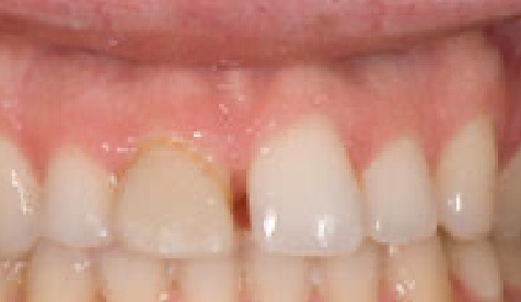 Closeup of smile with uneven gum line and gap between top teeth