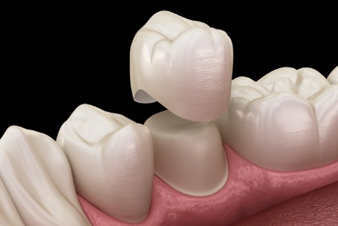 Animated smile during metal free dental crown placement