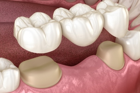 Animated smile during dental bridge placement