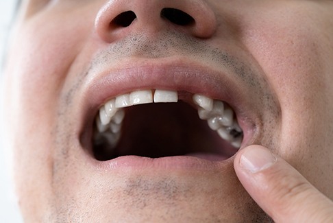 man pointing to missing tooth 