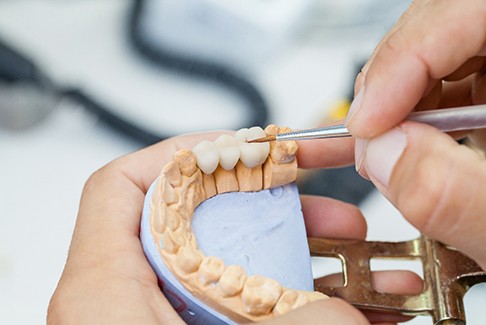 dentist shaping dental bridge 