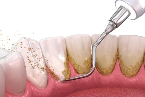 Animated smile during scaling and root planing gum disease treatment