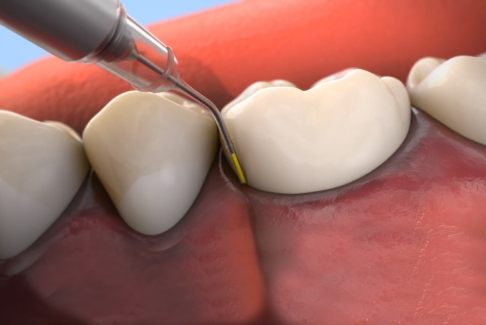 Animated smile during antibiotic therapy