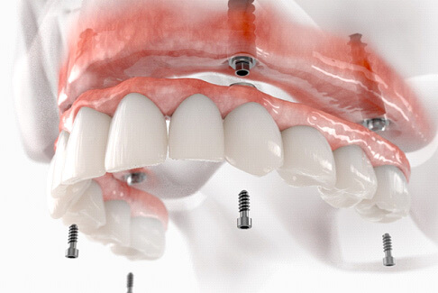 illustration of implant dentures on an upper arch