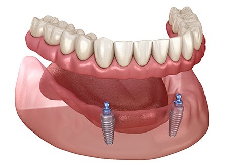 3D graphic of implant denture 