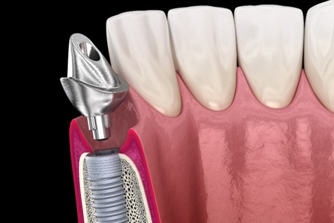 A 3D illustration of a dental implant and its abutment