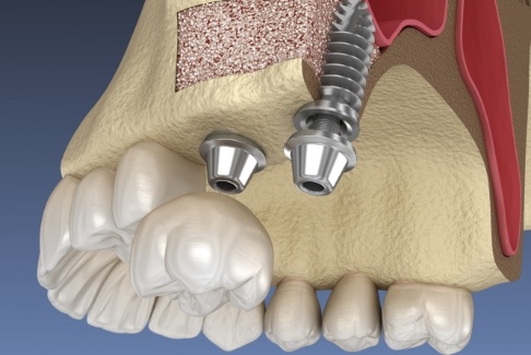 Animated smile after sinus lift bone grafting