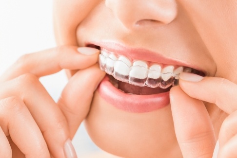 Closeup of person placing an Invisalign tray