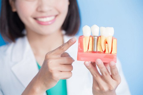 a closeup of a model of dental implants
