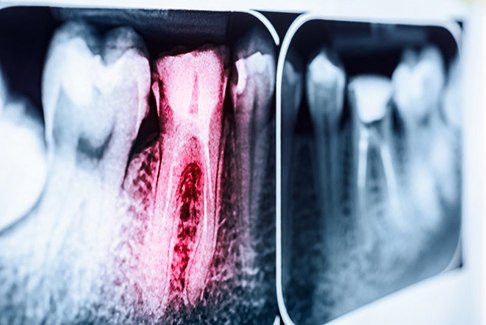 an X ray of a root canal