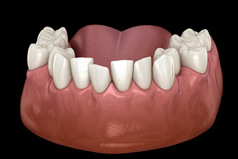 An illustration of crowded teeth
