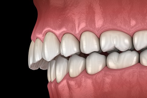 An illustration of a misaligned bite