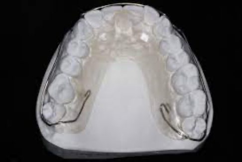 Model smile with Kois reprogrammer oral appliance in place