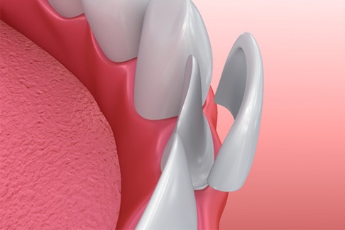 an illustration of the veneer process