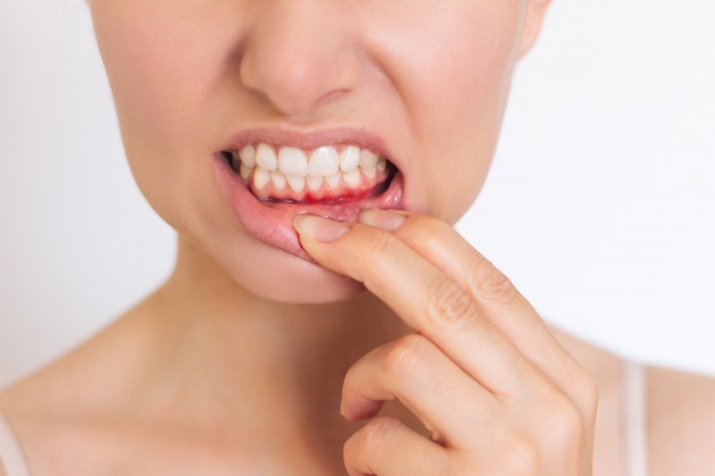 person exposing their red and swollen gum tissue