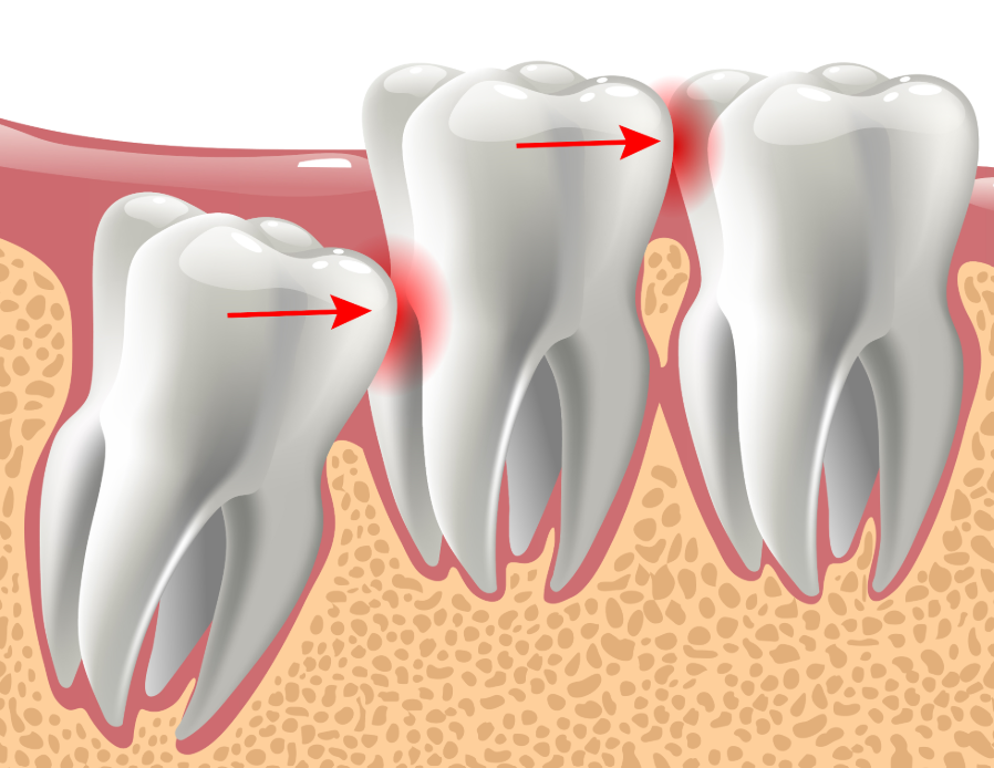 Illustrated cross section of wisdom teeth
